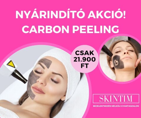 Nyárindító akció a Carbon Peeling szolgáltatásra